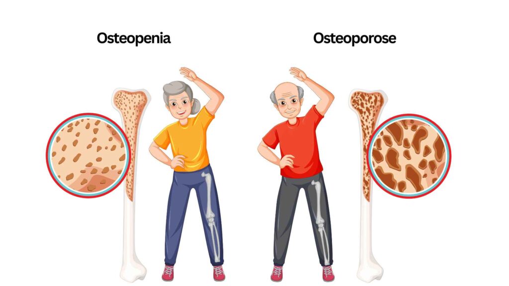 Diferença entre osteopenia e osteoporose