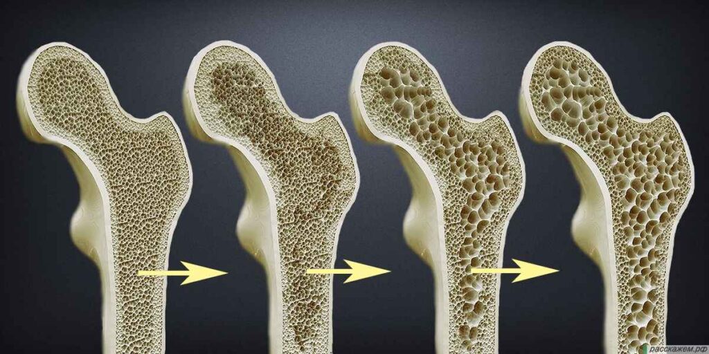 Evolução do osso normal até osteoporose